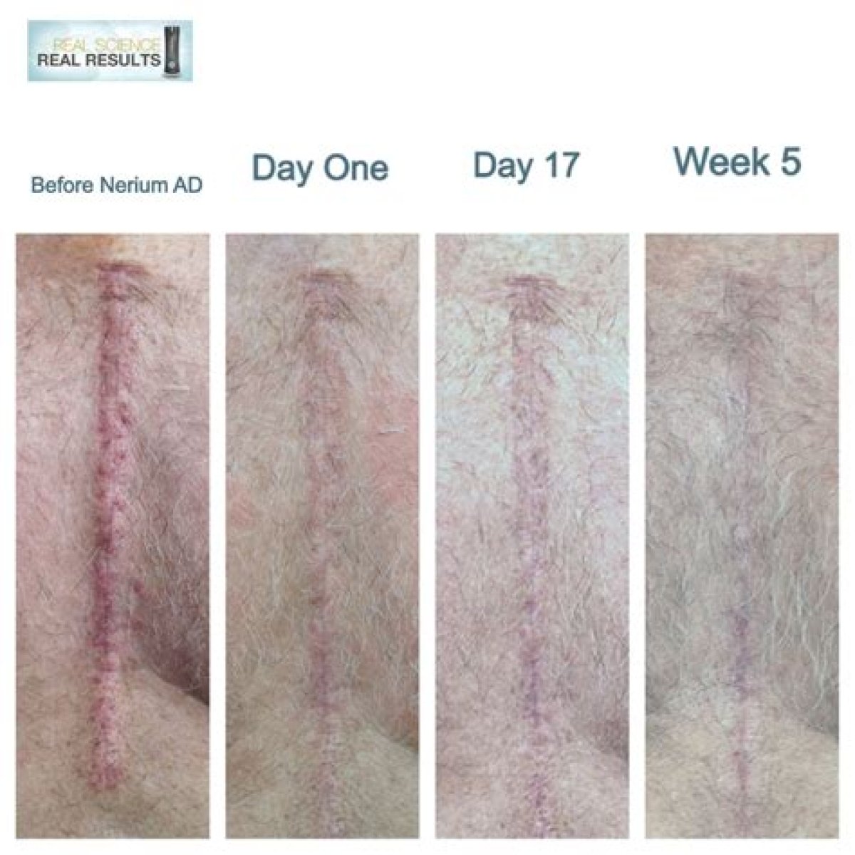 Understanding Scars From Open Heart Surgery: Healing And Acceptance